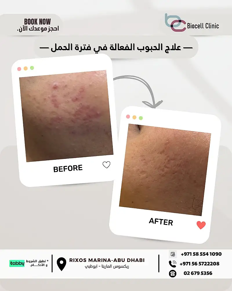 Treatment of Active Acne During Pregnancy