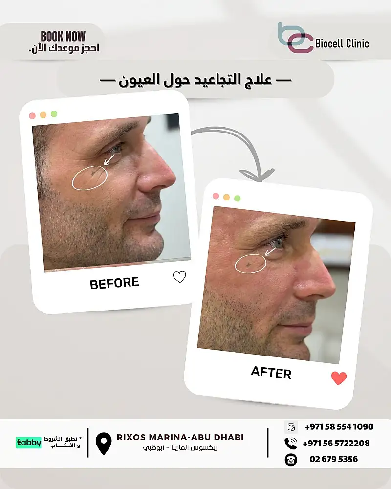 Eye Wrinkle Treatment