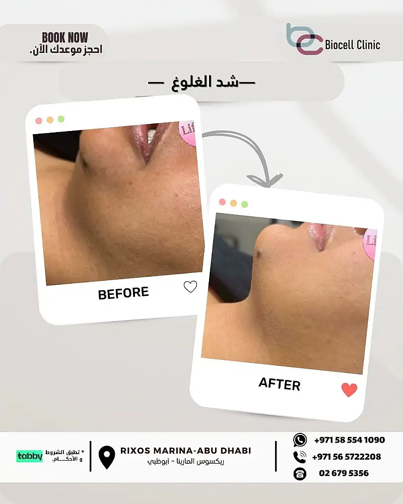 Double Chin Reduction