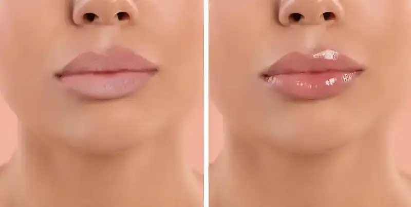 Botox Result