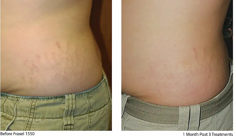 Stretch Marks Treatment
