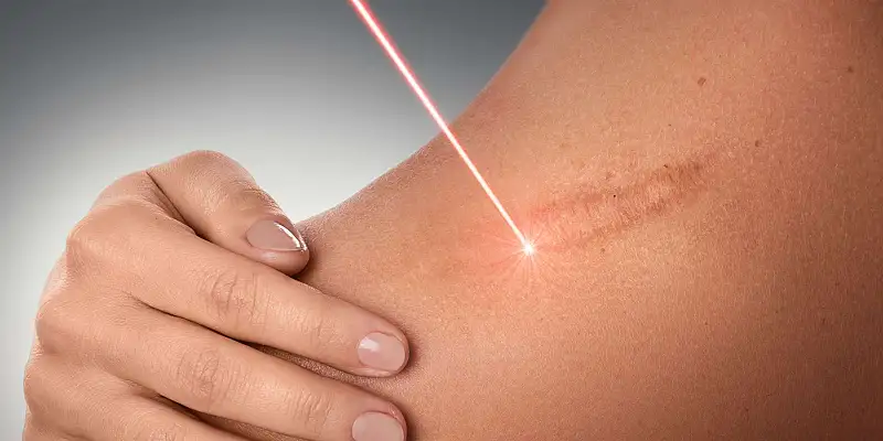 Scar Removal