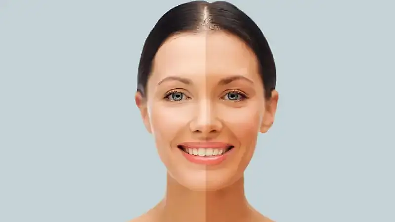 Skin Whitening